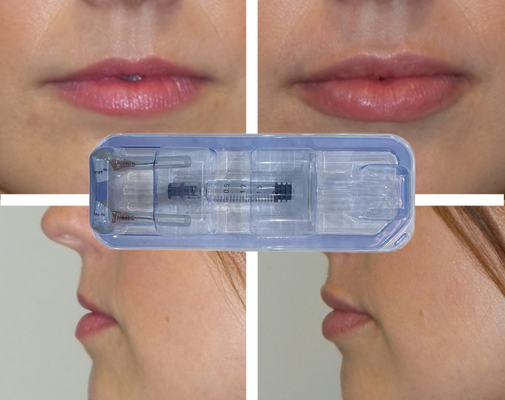 CE Ενέσιμη Ενέσιμη Υαλουρονικό Οξύ 24mg/ ml