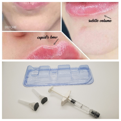 1 ml Juvederm Medical Sodium Hyaluronate Gel Hyaluronic Acid Gel Ενέσιμη για τη γέφυρα της μύτης