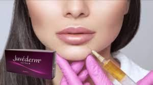 Juvederm Ultra 3 Υαλουρονικό οξύ HA Δερματικό γεμιστήρα 2 ml Ενίσχυση χειλιών