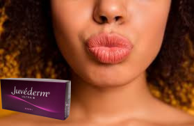 Juvederm Ultra 3 Ultra 4 Υαλουρονικό οξύ για τη βελτίωση των χειλιών