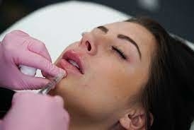 GMP Juvederm Ultra 3 HA Δερμικό Συμπλήρωμα για τα χείλη Juvederm Vollure
